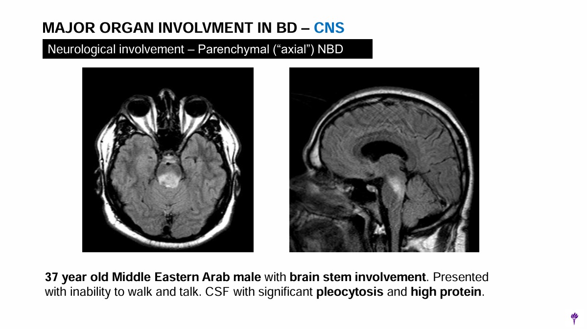 ERheumat's tweet photo. 7/10:
Neuro-Behçet's can involve parenchymal or vascular lesions, but not both together. GI involvement can mimic Crohn's, especially in East Asia. Pulmonary artery aneurysms are highly suggestive of Behçet's. 🧠#ACR24 #Behçets #OrganInvolvement https://t.co/rIfFzLbfhm