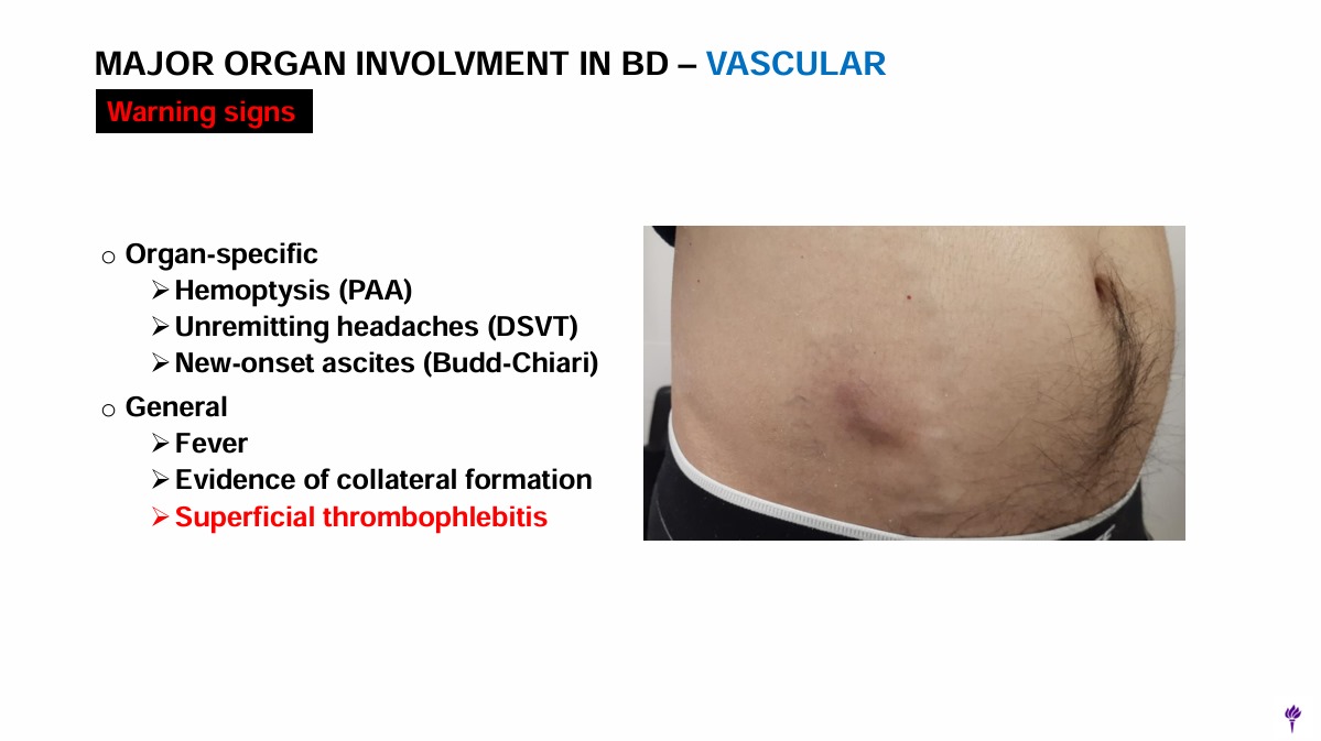 ERheumat's tweet photo. 7/10:
Neuro-Behçet's can involve parenchymal or vascular lesions, but not both together. GI involvement can mimic Crohn's, especially in East Asia. Pulmonary artery aneurysms are highly suggestive of Behçet's. 🧠#ACR24 #Behçets #OrganInvolvement https://t.co/rIfFzLbfhm