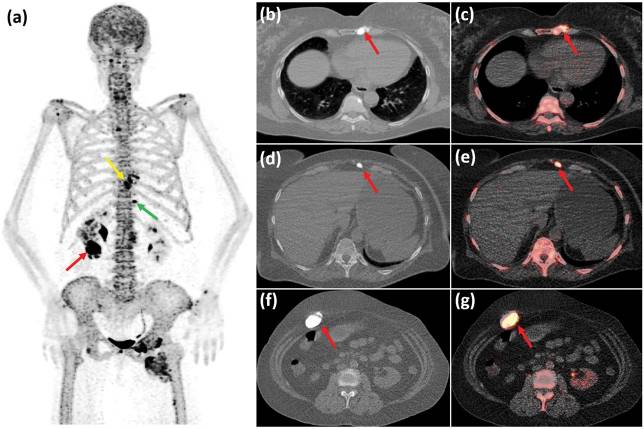 PuriTanuj's tweet photo. [18F]NaF PET for Melorheostosis #18FNaF #nucmed #molrad #nuclearmedicine #nuclearradiology #molecularimaging #petct #petmri #precisionmedicine #precisionimaging #BoneResearch #ImagingInnovation #BoneImaging  #BoneRemodeling #EarlyDetection
doi: 10.1097/RLU.0000000000001647 https://t.co/tTyW2blQS9