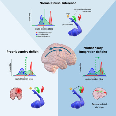 The Sense Innovation and Research Center (@_thesense_) on Twitter photo ð§ Body ownership alterations in stroke emerge from reduced proprioceptive precision and damage to the frontoparietal network
<a href="/MichiBassolino/">Michela Bassolino</a> co-authored a Med study.
ð Read: cell.com/med/fulltext/SâŠ
<a href="/hessovalais/">hessovalais</a> ð§ Body ownership alterations in stroke emerge from reduced proprioceptive precision and damage to the frontoparietal network
<a href="/MichiBassolino/">Michela Bassolino</a> co-authored a Med study.
ð Read: cell.com/med/fulltext/SâŠ
<a href="/hessovalais/">hessovalais</a>