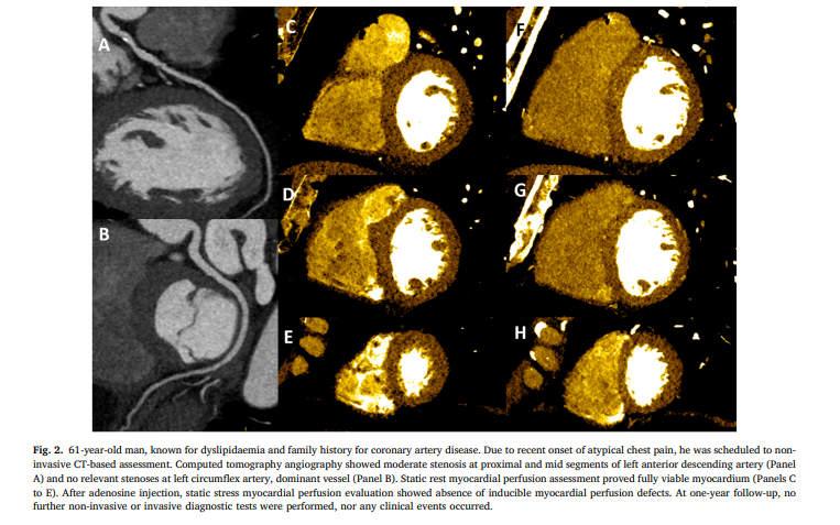 Journal of Cardiovascular CT (@journalcct) on Twitter photo <a href="/AndreBaggi/">Andrea Baggiano</a> et al show use of combined CCTA + Stress-CTP to evaluate symptomatic patients w/ intermediate to ⬆️risk for CAD or known CAD was associated w/ a favorable trend in terms of hard cardiac events & in identifying individuals at ⬇️risk, despite CAD
doi.org/10.1016/j.jcct… <a href="/AndreBaggi/">Andrea Baggiano</a> et al show use of combined CCTA + Stress-CTP to evaluate symptomatic patients w/ intermediate to ⬆️risk for CAD or known CAD was associated w/ a favorable trend in terms of hard cardiac events & in identifying individuals at ⬇️risk, despite CAD
doi.org/10.1016/j.jcct…
