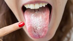 PharmSaj's tweet photo. If your tongue is like this, then this thread is for you.

A healthy tongue is typically pink in colour and covered with small nodules called papillae. However, if you notice a white coating on your tongue, it could be a sign of an underlying health issue.

Repost for others! https://t.co/Q2tKbBDoeM