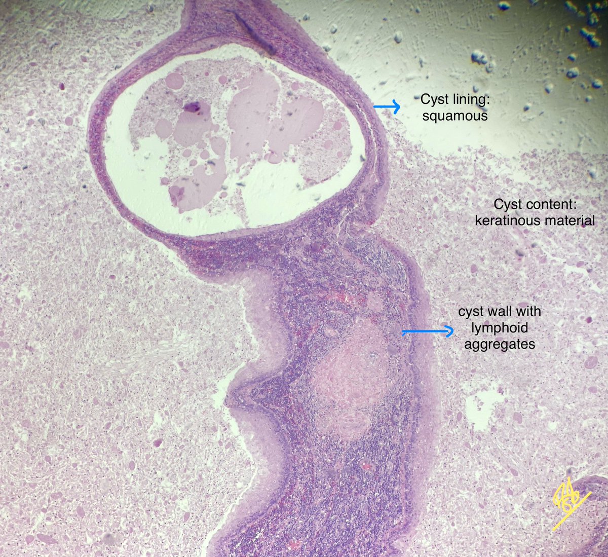 FatimaShamsPath's tweet photo. 📣 Diagnosis: Branchial cleft cyst

•Congenital lesions due to incomplete obliteration of the branchial apparatus
•Microscopy:
- Stratified squamous or ciliated columnar epithelium lining
- Fibrotic wall with lymphoid follicles resembling lymph node or tonsil
•Radiological correlation is very important
•Few questions that came up during discussion
•How to differentiate from thyroglossal cyst? TG cysts are usually midline and closely related to hyoid bone. Cyst lining varies and maybe denuded with severe inflammation. Thyroid inclusions present in many cases.
•Epidermoid cyst - Have appendages in the cyst wall and usually doesn’t show this degree of lymphoid aggregates. Radiological correlation is important.

#pathtwitter #pathology #pathresidents #surgpath
 
 Gross available here:

https://t.co/pP9MsigXDK