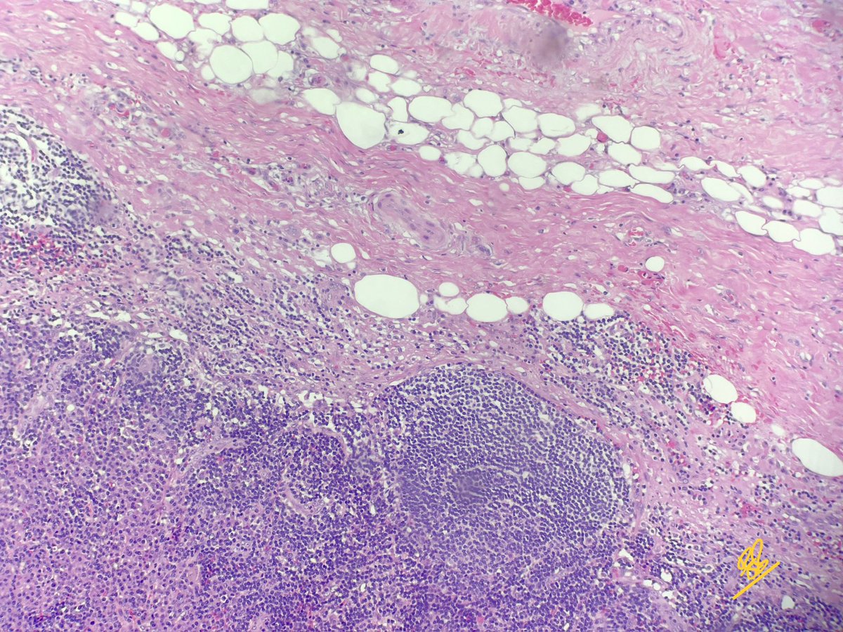 FatimaShamsPath's tweet photo. 📣 Diagnosis: Branchial cleft cyst

•Congenital lesions due to incomplete obliteration of the branchial apparatus
•Microscopy:
- Stratified squamous or ciliated columnar epithelium lining
- Fibrotic wall with lymphoid follicles resembling lymph node or tonsil
•Radiological correlation is very important
•Few questions that came up during discussion
•How to differentiate from thyroglossal cyst? TG cysts are usually midline and closely related to hyoid bone. Cyst lining varies and maybe denuded with severe inflammation. Thyroid inclusions present in many cases.
•Epidermoid cyst - Have appendages in the cyst wall and usually doesn’t show this degree of lymphoid aggregates. Radiological correlation is important.

#pathtwitter #pathology #pathresidents #surgpath
 
 Gross available here:

https://t.co/pP9MsigXDK
