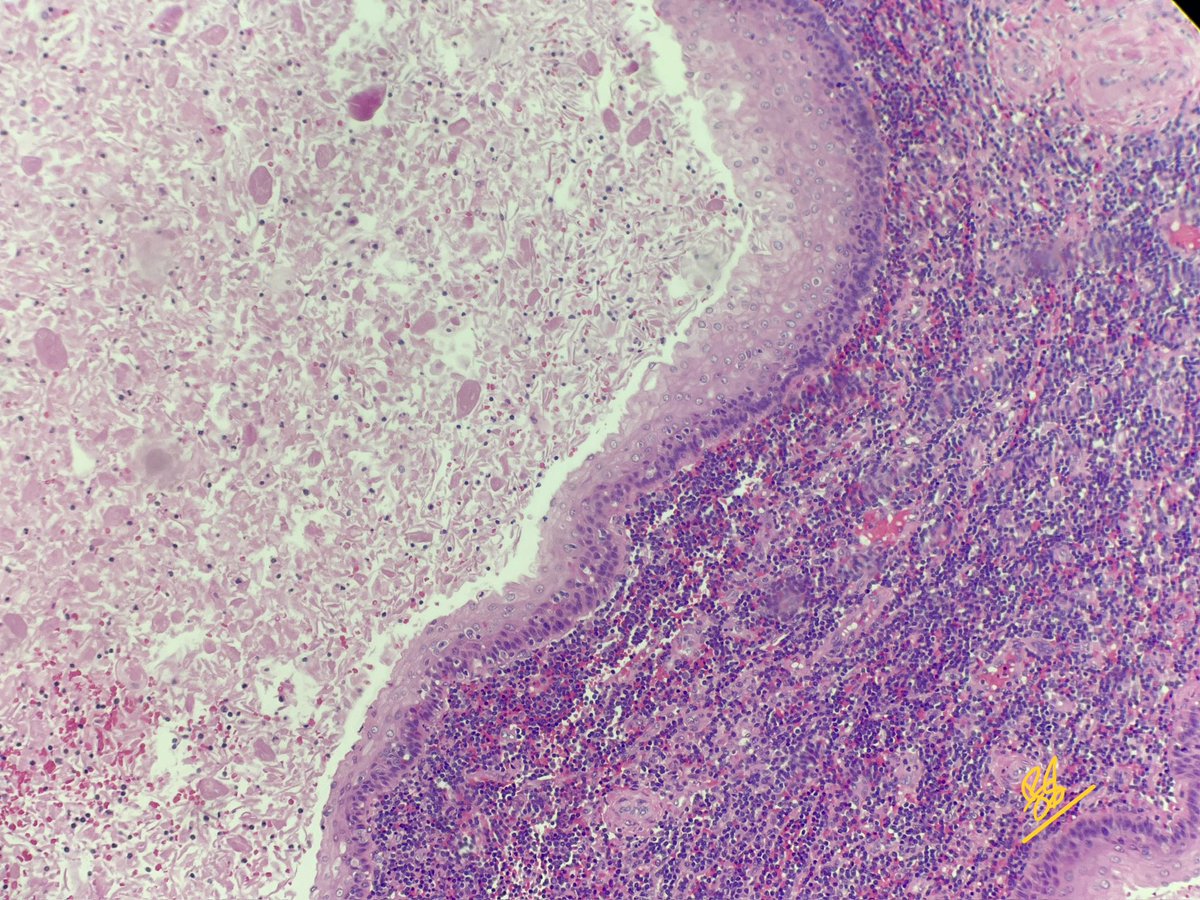 FatimaShamsPath's tweet photo. 📣 Diagnosis: Branchial cleft cyst

•Congenital lesions due to incomplete obliteration of the branchial apparatus
•Microscopy:
- Stratified squamous or ciliated columnar epithelium lining
- Fibrotic wall with lymphoid follicles resembling lymph node or tonsil
•Radiological correlation is very important
•Few questions that came up during discussion
•How to differentiate from thyroglossal cyst? TG cysts are usually midline and closely related to hyoid bone. Cyst lining varies and maybe denuded with severe inflammation. Thyroid inclusions present in many cases.
•Epidermoid cyst - Have appendages in the cyst wall and usually doesn’t show this degree of lymphoid aggregates. Radiological correlation is important.

#pathtwitter #pathology #pathresidents #surgpath
 
 Gross available here:

https://t.co/pP9MsigXDK