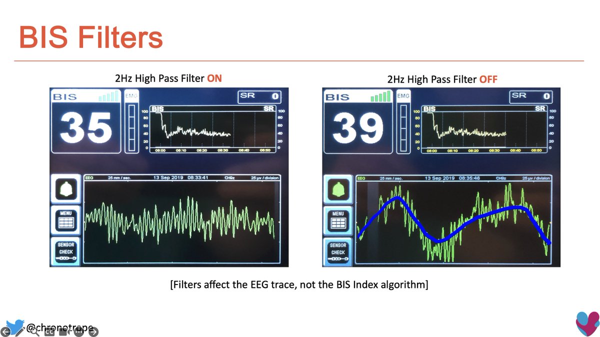 I grumble about the heavy-handed 2Hz high pass filter on the BIS monitor which prevents visualisation of slow and delta oscillations [default: ON], I found reference (and warning!) to this from 1987!
Pleased that <a href="/Medtronic/">Medtronic</a> are finally listening with incoming updates in 2025!