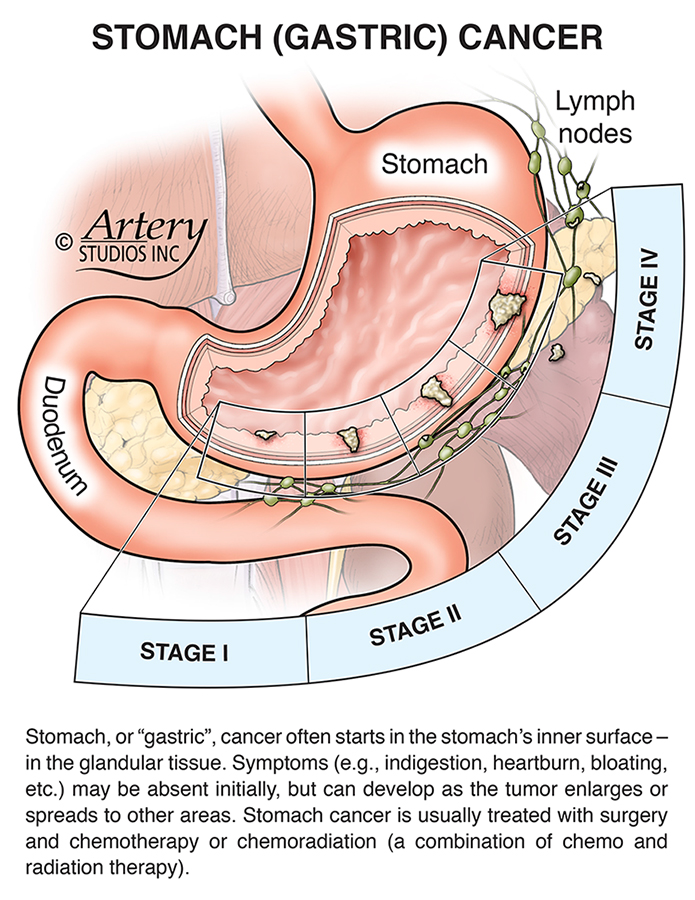 December is Stomach Cancer Awareness Month –

#medicalillustration #medicalanimation