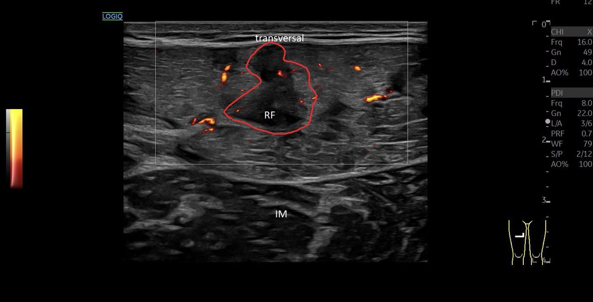 SportklinikBern's tweet photo. Complete central tendon rupture of the #rectusfemoris in #mskus #pocus #pocushub #GElogiqE10sr4 @Rheumatology https://t.co/jzT4z4emkU