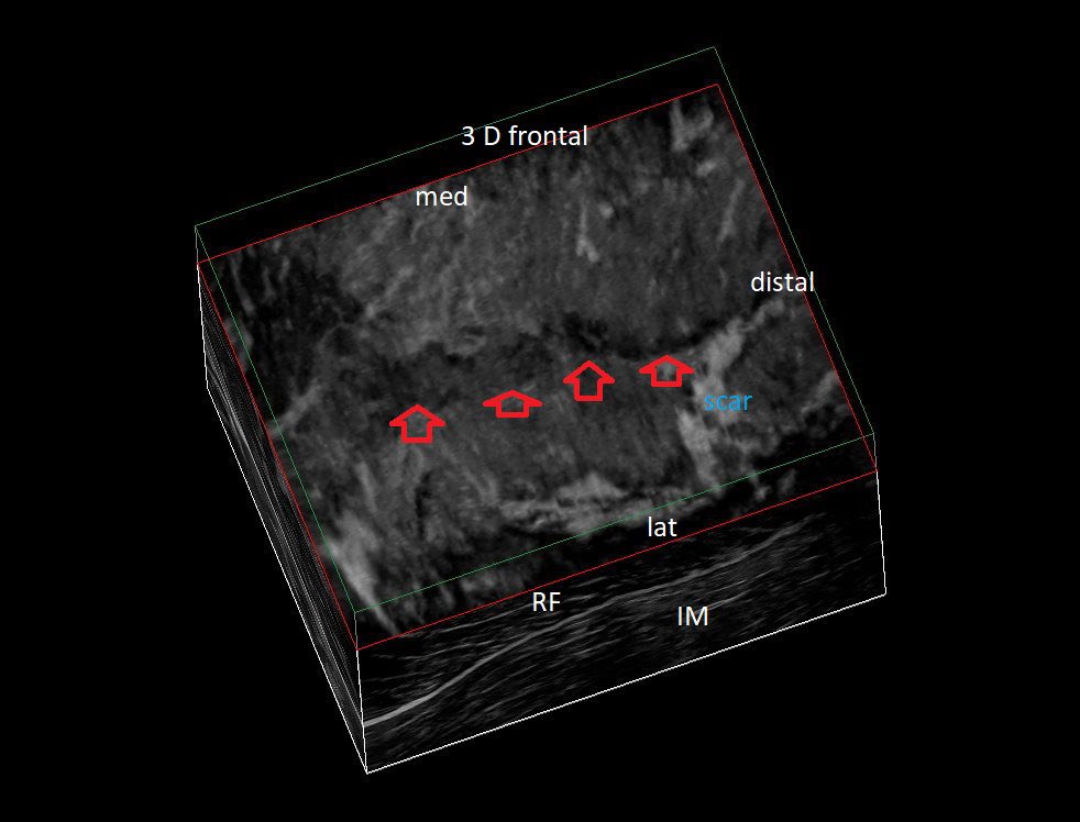 SportklinikBern's tweet photo. Complete central tendon rupture of the #rectusfemoris in #mskus #pocus #pocushub #GElogiqE10sr4 @Rheumatology https://t.co/jzT4z4emkU