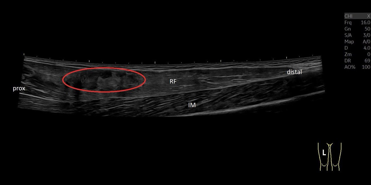 SportklinikBern's tweet photo. Complete central tendon rupture of the #rectusfemoris in #mskus #pocus #pocushub #GElogiqE10sr4 @Rheumatology https://t.co/jzT4z4emkU