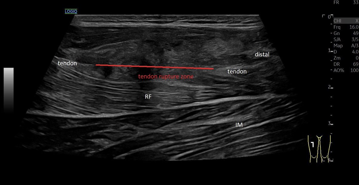 SportklinikBern's tweet photo. Complete central tendon rupture of the #rectusfemoris in #mskus #pocus #pocushub #GElogiqE10sr4 @Rheumatology https://t.co/jzT4z4emkU
