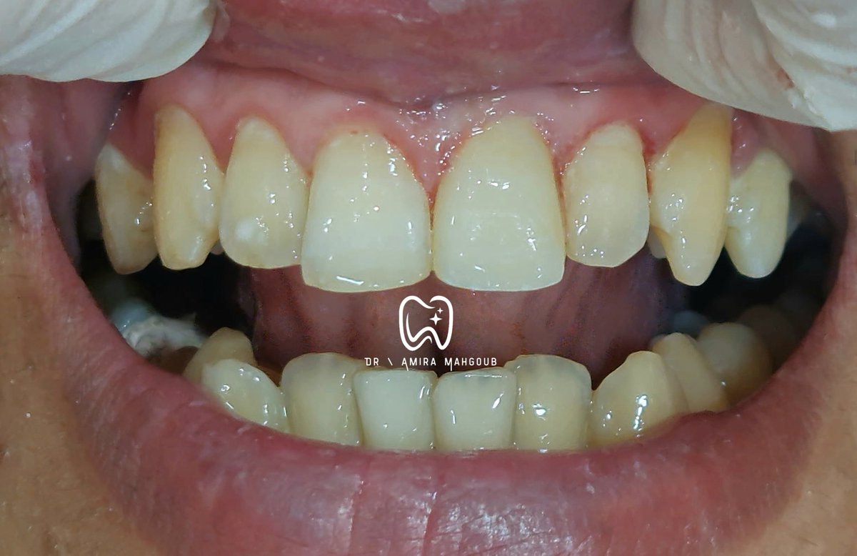 meerrryyyyy's tweet photo. جايلكم بعد فتره غياااااب طويله ب 
Single upper centeral incisor crown 😌���� https://t.co/t9kRCW3pLv
