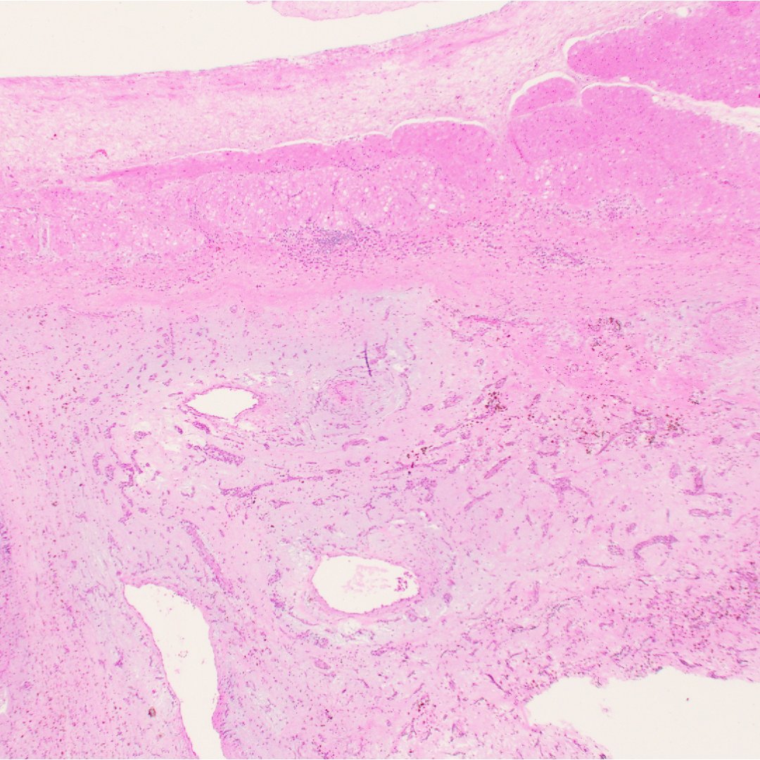 MGBpathology's tweet photo. Happy Tissue Tuesday!

Let's focus on the ❤️. What’s your diagnosis for this left atrial lesion? (answer in comments)

HPI: Adult patient w/ hx of syncopal episodes, now p/w acute hemiparesis. An echocardiogram reveals the culprit. https://t.co/bqcOLcjG6T
