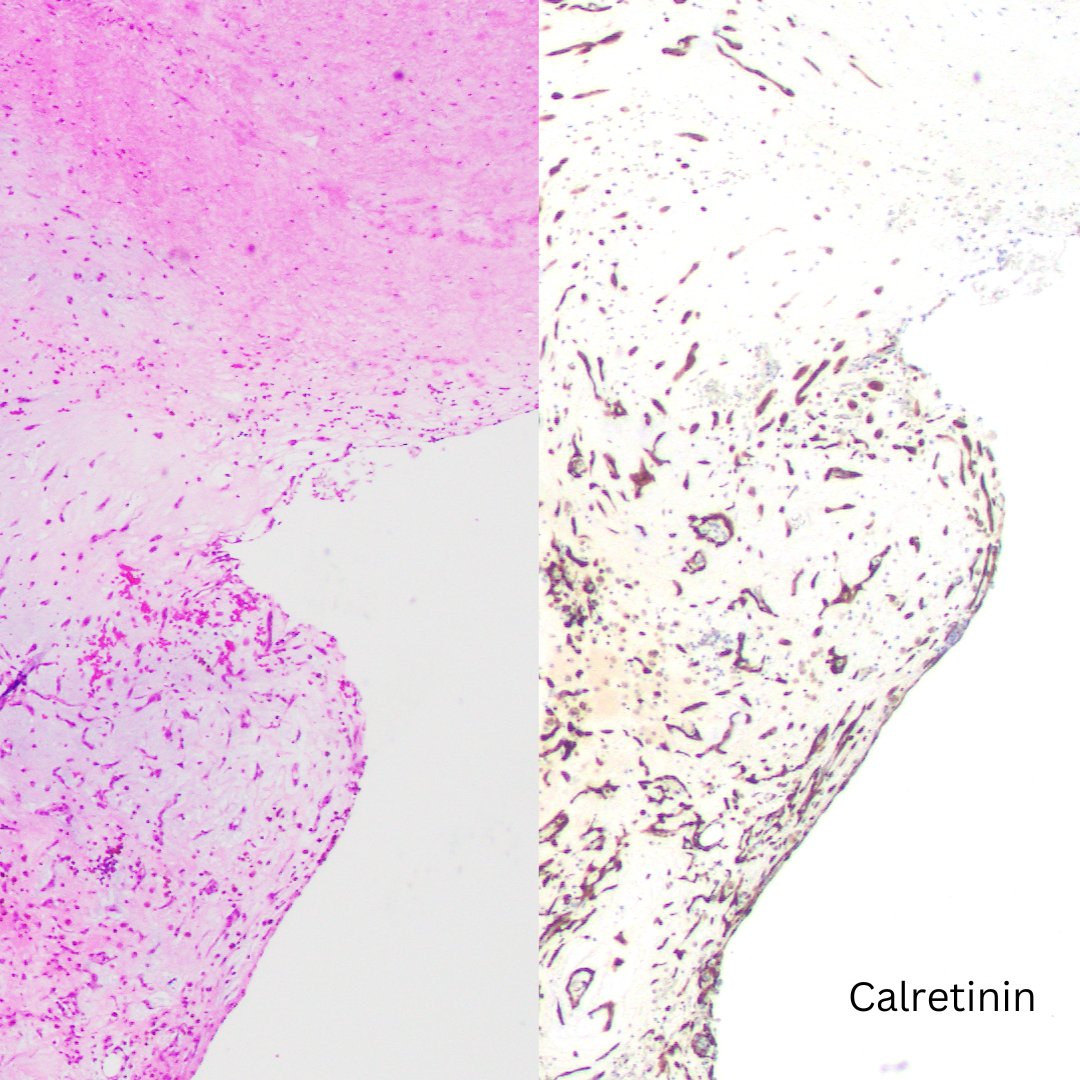 Happy Tissue Tuesday!

Let's focus on the ❤️. What’s your diagnosis for this left atrial lesion? (answer in comments)

HPI: Adult patient w/ hx of syncopal episodes, now p/w acute hemiparesis. An echocardiogram reveals the culprit.