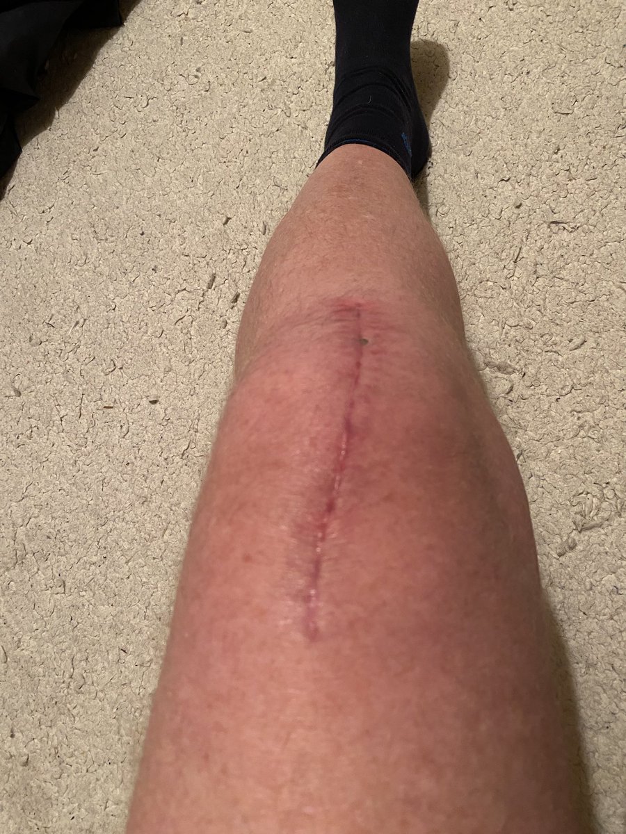 Stuart Davies (@stuart_davies8) on Twitter photo 6 week review with consultant <a href="/stuartroy2/">Stuart Roy</a> following a knee replacement.
All gone to plan, and rehab being expertly overseen by <a href="/gd_physio/">GD Physio</a>.
Thanks to Doc Roy for doing a great job, and <a href="/ConformisUk/">Conformis UK</a> for the knee technology.
Wonder if itās cured my power fade! šļø 6 week review with consultant <a href="/stuartroy2/">Stuart Roy</a> following a knee replacement.
All gone to plan, and rehab being expertly overseen by <a href="/gd_physio/">GD Physio</a>.
Thanks to Doc Roy for doing a great job, and <a href="/ConformisUk/">Conformis UK</a> for the knee technology.
Wonder if itās cured my power fade! šļø