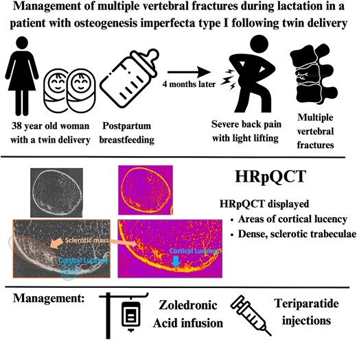 JBMRPlus (@jbmrplus) on Twitter photo A new article in #JBMRPlus report the first case of a woman with twin pregnancy and osteogenesis imperfecta (OI) type I who presented with multiple vertebral #fractures following delivery and post-partum lactation <a href="/Zebaze1R/">Roger Zebaze</a>
#openaccess
Read more here: ow.ly/v4HI50UmJJP A new article in #JBMRPlus report the first case of a woman with twin pregnancy and osteogenesis imperfecta (OI) type I who presented with multiple vertebral #fractures following delivery and post-partum lactation <a href="/Zebaze1R/">Roger Zebaze</a>
#openaccess
Read more here: ow.ly/v4HI50UmJJP