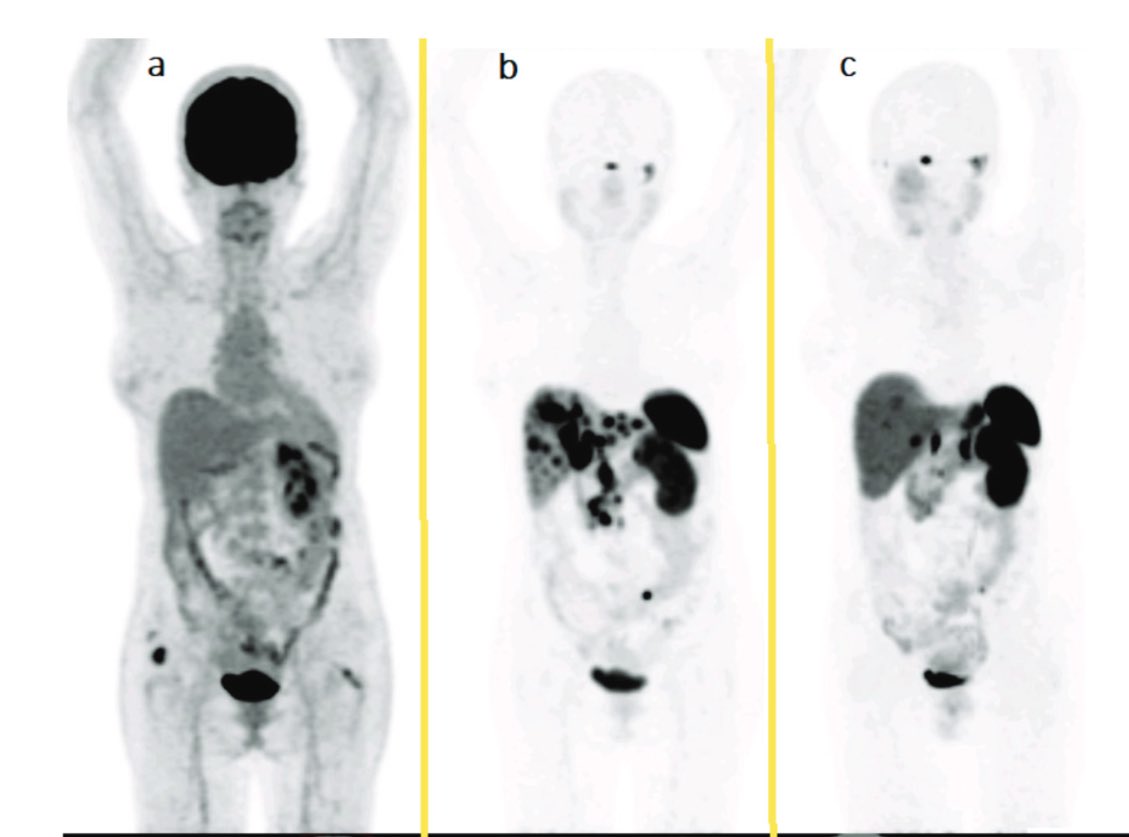 Successful treatment of a patient with multiple primary metachronous malignancies, including #NET in 2009, (meningioma in 2010), uterine cancer in 2017, and breast cancer in 2019. The patient received #PRRT at our center in 2016.
It's essential to prioritize #PrecisionMedicine.