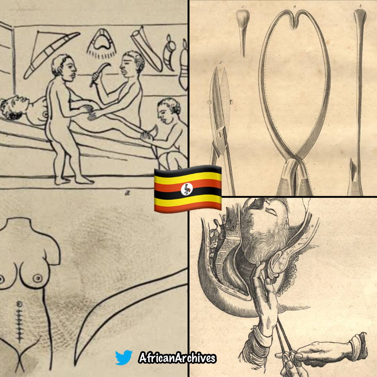 The Banyole of the ancient kingdom Of Uganda practiced and perfected C-Section long before the Europeans.

While Europeans mainly concentrated on saving the baby, the ugandans were performing the operation successfully saving both. 

A THREAD