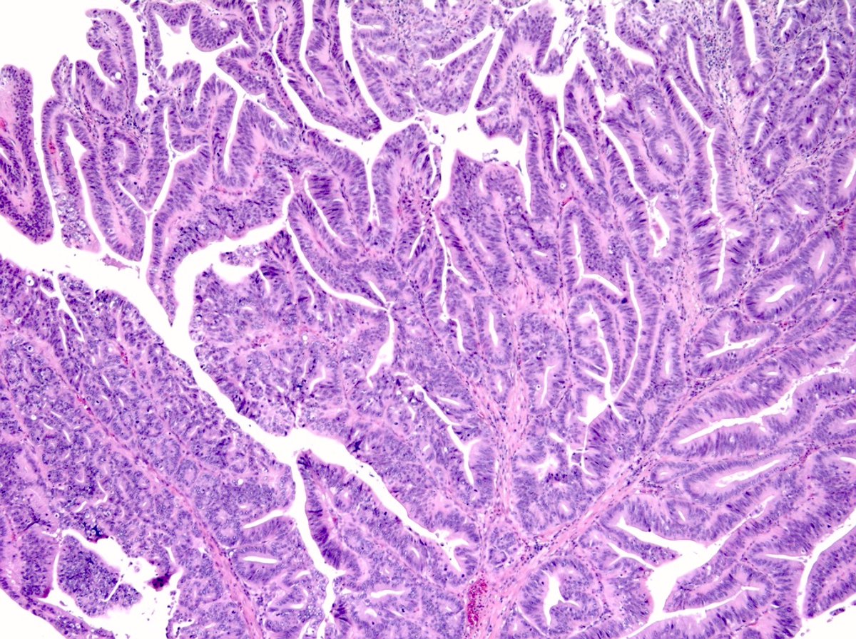 CuringN's tweet photo. Small intestine &amp; ampulla - What's your diagnosis?

Topic link: https://t.co/ucu9UVAXgC

Images contributed by Claudio Luchini, M.D., Ph.D. and Felicia D. Allard, M.D.

#Cancer #CancerResearch #CuringCancerNetwork #Pathology https://t.co/WucGqCysrM