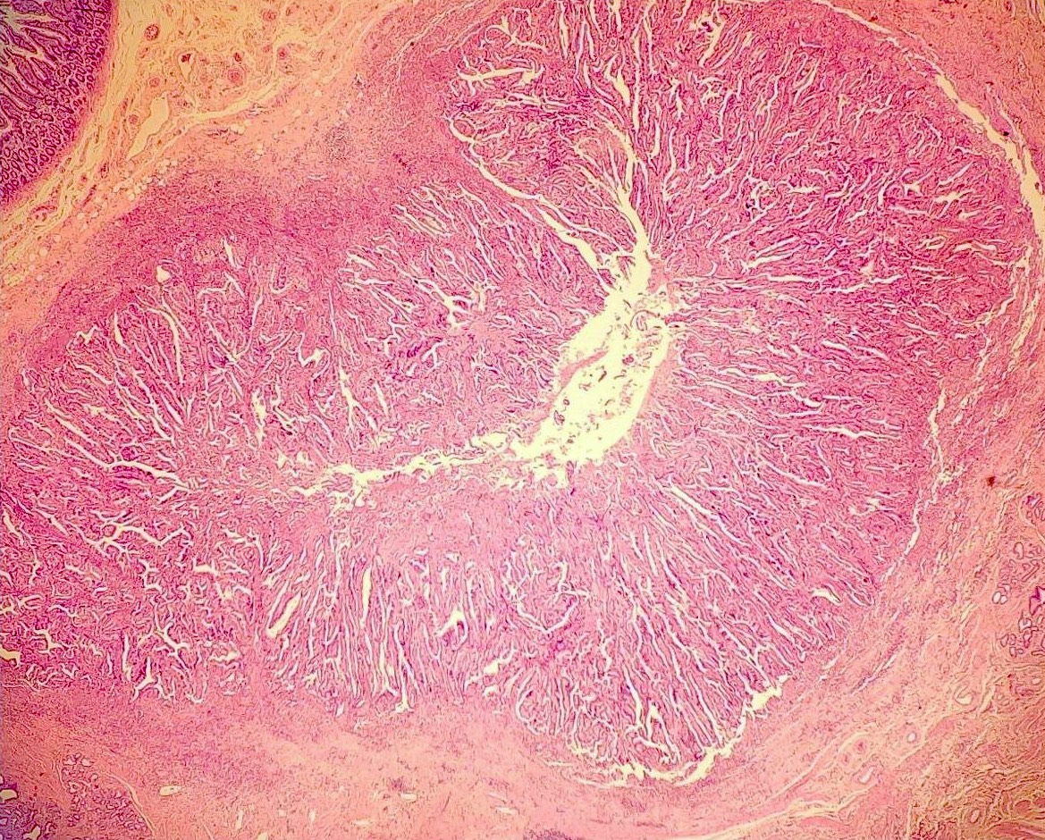 CuringN's tweet photo. Small intestine &amp; ampulla - What's your diagnosis?

Topic link: https://t.co/ucu9UVAXgC

Images contributed by Claudio Luchini, M.D., Ph.D. and Felicia D. Allard, M.D.

#Cancer #CancerResearch #CuringCancerNetwork #Pathology https://t.co/WucGqCysrM