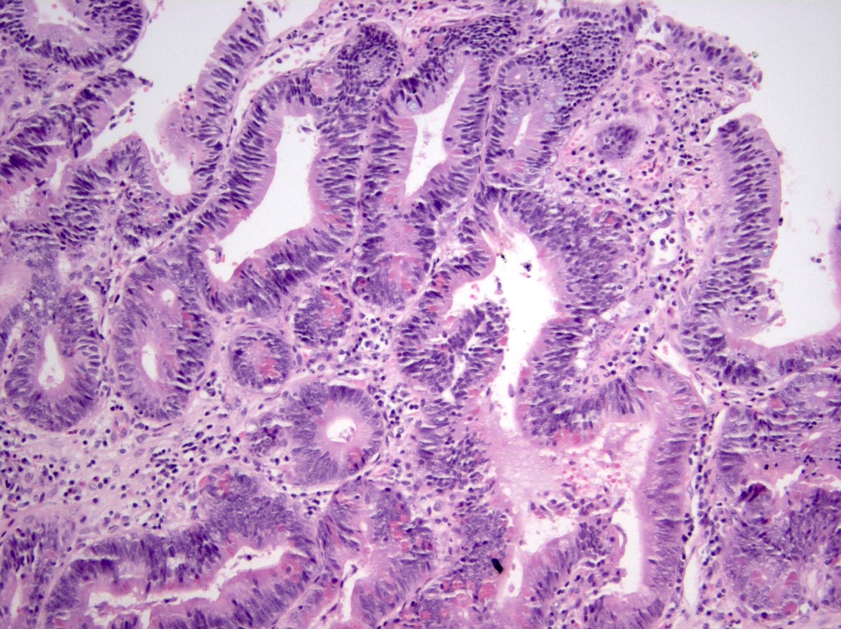 CuringN's tweet photo. Small intestine &amp; ampulla - What's your diagnosis?

Topic link: https://t.co/ucu9UVAXgC

Images contributed by Claudio Luchini, M.D., Ph.D. and Felicia D. Allard, M.D.

#Cancer #CancerResearch #CuringCancerNetwork #Pathology https://t.co/WucGqCysrM