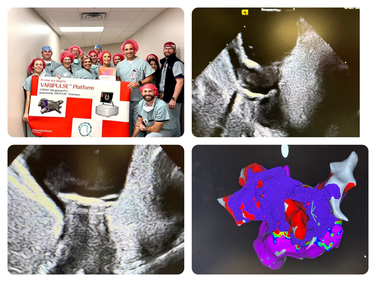 Thrilled to have performed my first zero-fluoro Varipulse procedure today, leveraging CARTO 3 seamlessly integrated with the cutting-edge SoundStar Crystal ICE catheter!

The enhanced clarity, precision, and safety features are game-changing—not just for patients, but for the