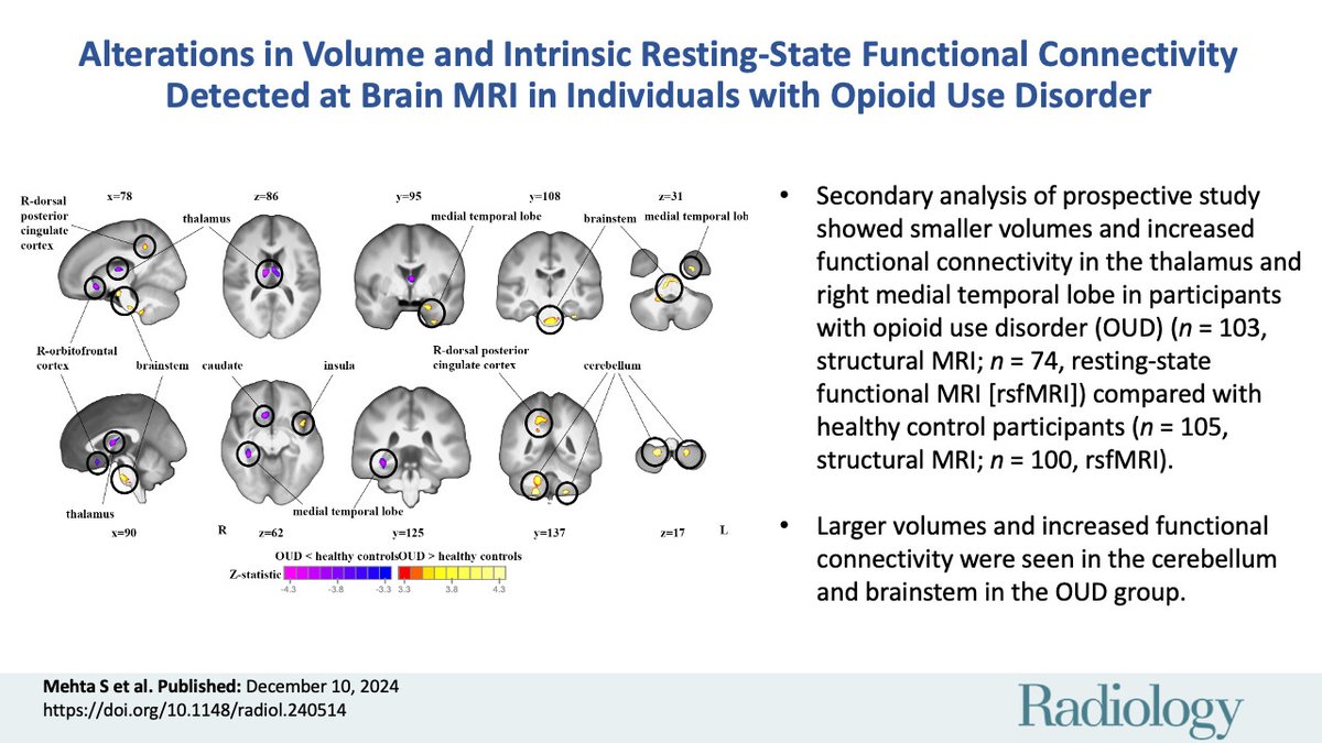 Alterations in Volume and Intrinsic Resting-State Functional Connectivity Detected at Brain MRI in Individuals with Opioid Use Disorder | Radiology pubs.rsna.org/doi/10.1148/ra…