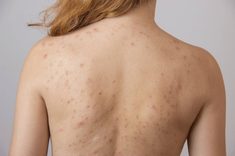 QueenTelekungSK's tweet photo. Weh baru tahu rupanya gurls pun ramai struggle dengan bacne (jerawat badan). 😮” https://t.co/PAJJT4rCXM
