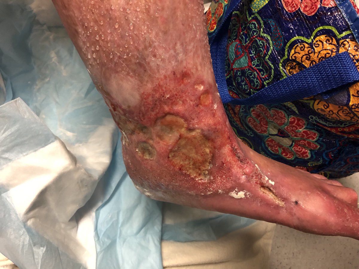 Janetbirdope's tweet photo. #pyoderma #gangrenosum 

How to treat? https://t.co/XhuJCdBMHd
