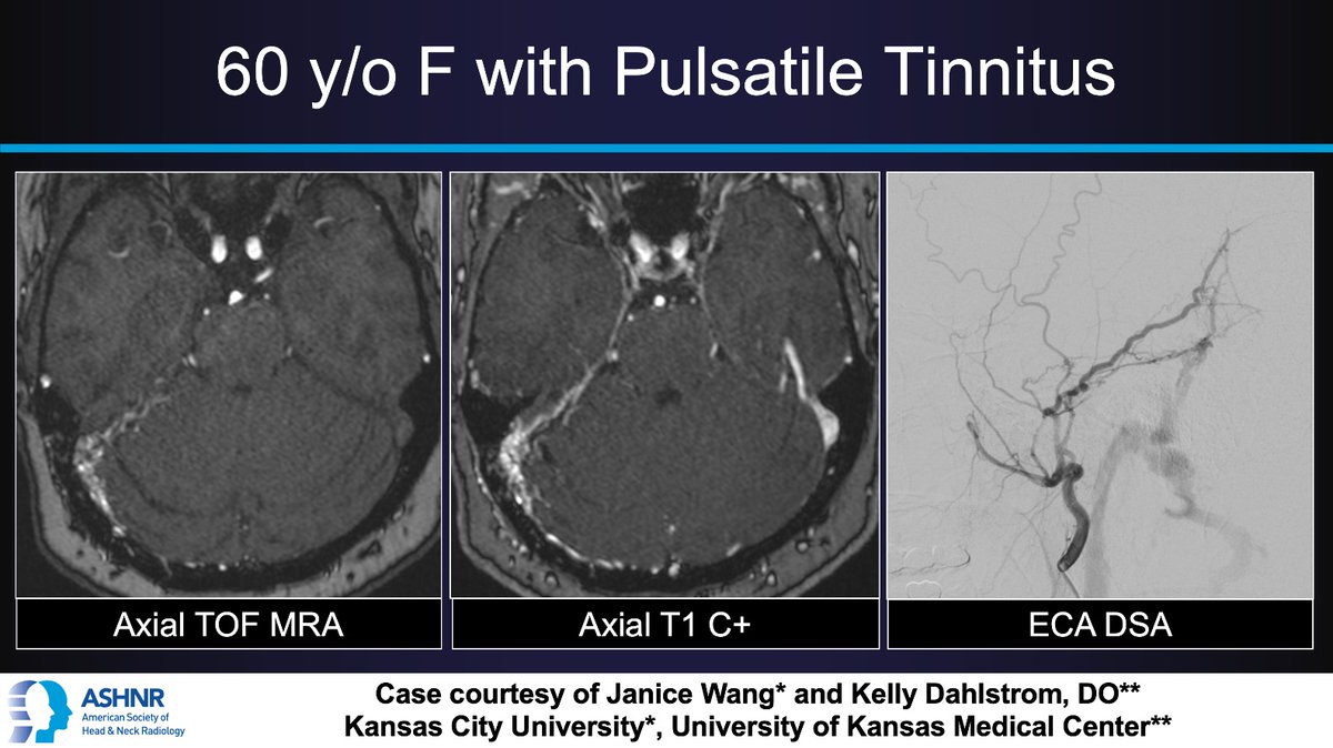 ASHNR (@ashnrsociety) on Twitter photo #ASHNRCOTW #278: Pulsatile Tinnitus. Thx
Janice Wang + <a href="/kelly_dahlstrom/">Kelly Dahlstrom</a> 4 case! #ASHNR25
Answer w/ appropriate GIF only -- stay professional & don't spoil it!
<a href="/callyrobs/">Caroline Robson, MBChB</a> <a href="/DShatzkes/">Deborah Shatzkes</a> <a href="/CDP_Rad/">C Douglas Phillips 🇺🇸</a> <a href="/rhwiggins/">Richard Wiggins</a>
<a href="/nakoontz/">Nicholas Koontz</a> <a href="/KRileyMD/">Kalen Riley</a> <a href="/CMGlastonbury/">Christine M Glastonbury, MD</a>
<a href="/tabby_kennedy/">Tabby A. Kennedy, MD</a> <a href="/PhilipRChapman1/">Philip R. Chapman, MD</a> #ASHNRCOTW #278: Pulsatile Tinnitus. Thx
Janice Wang + <a href="/kelly_dahlstrom/">Kelly Dahlstrom</a> 4 case! #ASHNR25
Answer w/ appropriate GIF only -- stay professional & don't spoil it!
<a href="/callyrobs/">Caroline Robson, MBChB</a> <a href="/DShatzkes/">Deborah Shatzkes</a> <a href="/CDP_Rad/">C Douglas Phillips 🇺🇸</a> <a href="/rhwiggins/">Richard Wiggins</a>
<a href="/nakoontz/">Nicholas Koontz</a> <a href="/KRileyMD/">Kalen Riley</a> <a href="/CMGlastonbury/">Christine M Glastonbury, MD</a>
<a href="/tabby_kennedy/">Tabby A. Kennedy, MD</a> <a href="/PhilipRChapman1/">Philip R. Chapman, MD</a>