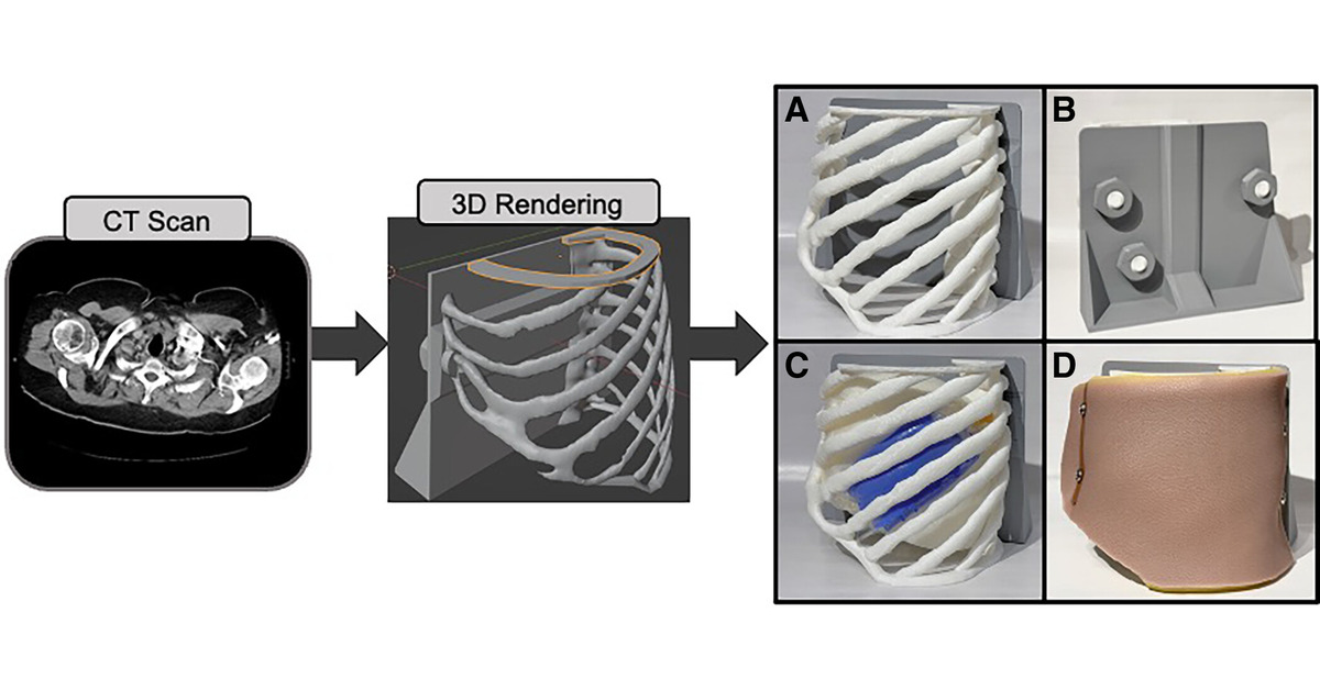 Explor-A-Thora: A Novel 3D-printed Pleural Simulator

Explor-A-Thora! A low-cost, 3D-printed pleural procedure simulator with realistic tactile feedback #MedEd #Innovation #3DPrinting #SimulationTraining
<a href="/IlanaKrumm/">Ilana Krumm</a> 
<a href="/atscommunity/">American Thoracic Society (ATS)</a> 

🔗 tinyurl.com/2p8vw2ds