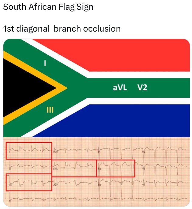 High lateral wall STEMI (South Africa flag sign). 
youtube.com/@jackcfchong