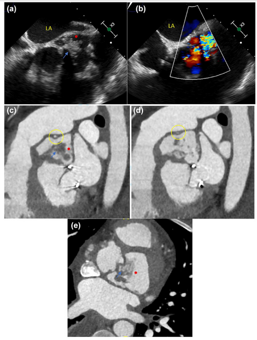 Bo Xu MD, FACC, FASE tweet media