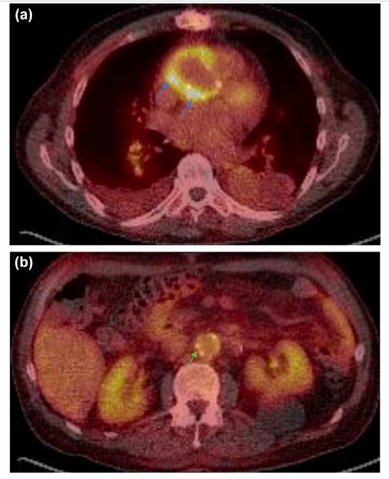Bo Xu MD, FACC, FASE tweet media