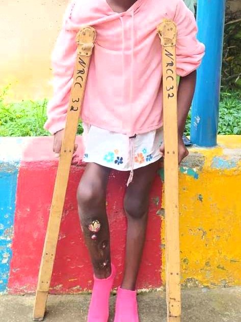 Myths about osteomyelitis worsen conditions. Break the myth: it's not witchcraft or a curse, but a treatable condition. Prioritize medical care for our children. Early treatment prevents long-term damage and disability. #OsteomyelitisAwareness #HealthEducationMatters