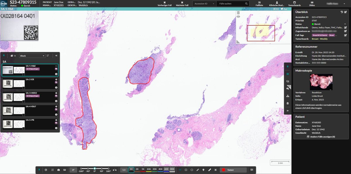 Indica Labs (@indica_labs) on Twitter photo We’re excited to announce that <a href="/igmp_unibern/">Institute of Tissue Medicine and Pathology</a> has selected our HALO AP platform for the first-in-country diagnostic #DigitalPathology deployment in the cloud powered by <a href="/awscloud/">Amazon Web Services</a>.
Read our press release to learn more: indicalab.com/news/the-insti…
#PathX #PathologyLabs #CloudServices We’re excited to announce that <a href="/igmp_unibern/">Institute of Tissue Medicine and Pathology</a> has selected our HALO AP platform for the first-in-country diagnostic #DigitalPathology deployment in the cloud powered by <a href="/awscloud/">Amazon Web Services</a>.
Read our press release to learn more: indicalab.com/news/the-insti…
#PathX #PathologyLabs #CloudServices