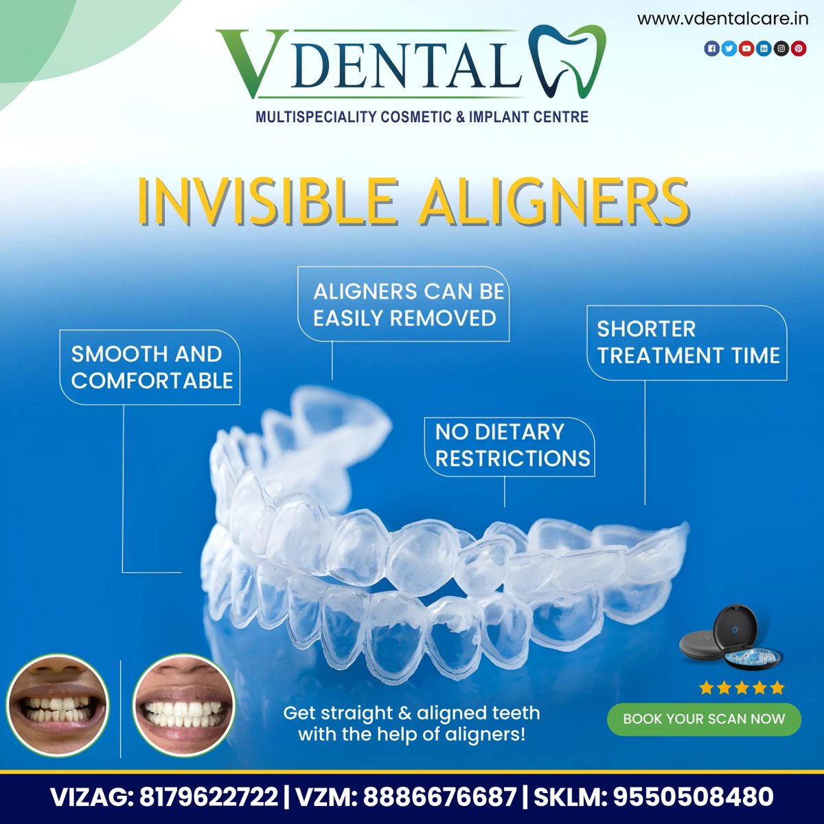 vdentalhospital's tweet image. 😃 INVISIBLE ALIGNERS – Your Path to a Perfect Smile!

VIZAG: 8179622722
VZM: 8886676687

SKLM: 9550508480

💻 Visit vdentalcare.in to learn more

#InvisibleAligners #PerfectSmile #TeethAlignment #ComfortableOrthodontics #StraightTeeth #VDentalCare #VizagDentistry