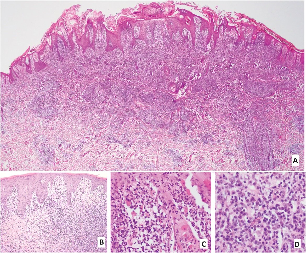 AJDP_Journal's tweet photo. #ClinicalPathologicChallenge
43YM, smoker, with h/o Crohn disease p/w asymptomatic, infiltrated erythematous ulcerated nodules on the dorsum of his left hand & on anterior right & left thighs
Fig 3: (A)CD3 (B)CD20 (C)CD4 (D)CD30 (E)CD68 (F)CD8 (G)Kappa (H)Lambda
What's your Dx? https://t.co/LsHV9KpuHm