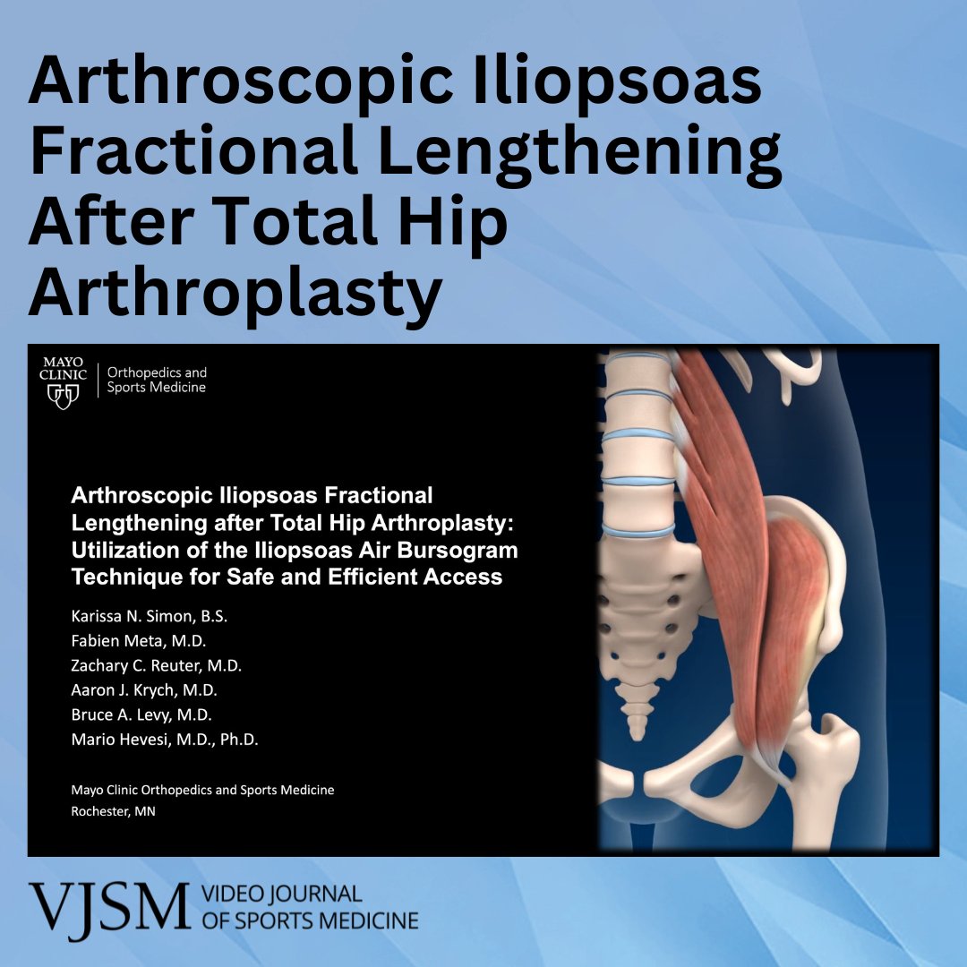 New VJSM video demonstrating the use of an air bursogram for safe and efficient access when performing an arthroscopic iliopsoas tendon fractional lengthening in patients status post total hip arthroplasty. ow.ly/QAqK50Ucic8 <a href="/MarioHevesiMD/">Mario Hevesi MD PhD</a> <a href="/DrKrych/">Dr. Aaron J. Krych</a> <a href="/MayoOrtho/">Mayo Sports Research</a> <a href="/MayoHipPres/">Mayo Clinic Hip Preservation</a>