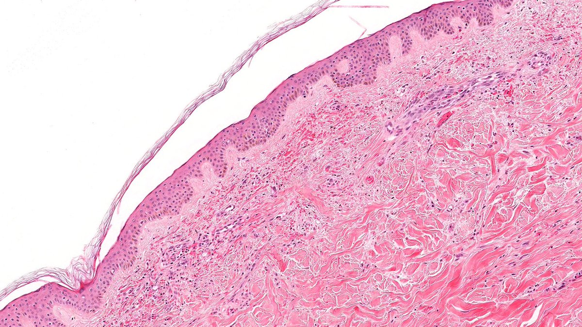 RazaHoda's tweet image. Case of Postradiation Angiosarcoma (RT-AS) 🔬

RT-AS is found in superficial breast or chest wall of patients who received adjuvant radiation therapy, shows infiltrative channels with atypical endothelial cells, and has MYC gene amplification.

#PathTwitter #PathX #breastpath