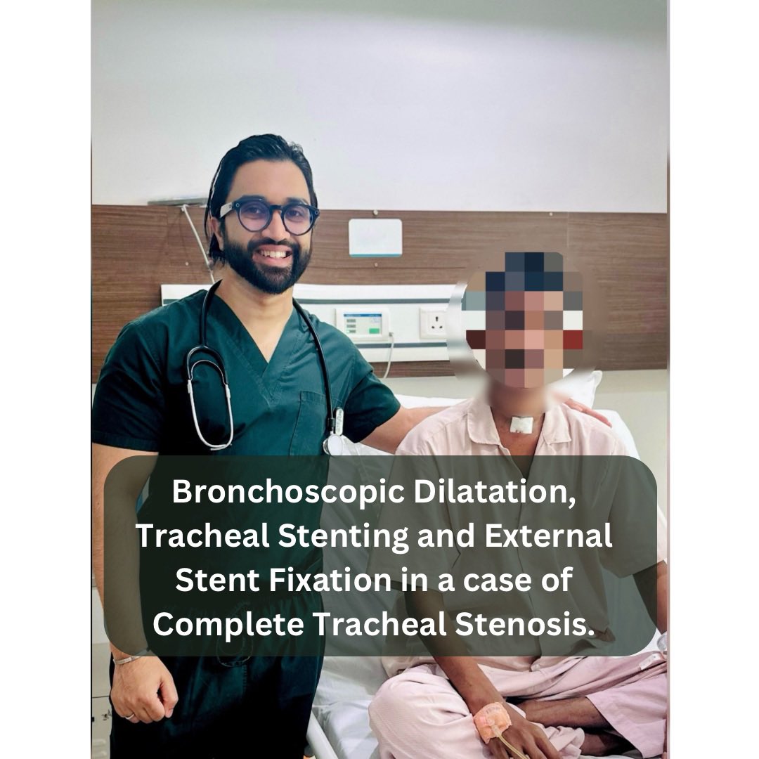 arbat_dr's tweet photo. Bronchoscopic dilatation, Tracheal Stenting and external stent fixation in a case of complete tracheal stenosis. @arbat_dr 

#trachealstenting #interventionalpulmonology  #drsameerarbat #onehealthcare #pulmonologist #nagpur #india🇮🇳 https://t.co/cNku4jRwVC