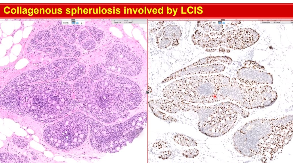 Janiranavarro's tweet image. Breast
Collagenous spherulosis involved by LCIS

p63(right pic)
SMMHC(left pic)

Dr. Li #CAP24 #pathology #pathologists #PathTwitter #PathX #pathresidents #pathfellow #breastpath