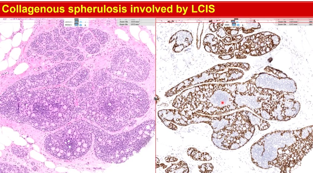 Janiranavarro's tweet image. Breast
Collagenous spherulosis involved by LCIS

p63(right pic)
SMMHC(left pic)

Dr. Li #CAP24 #pathology #pathologists #PathTwitter #PathX #pathresidents #pathfellow #breastpath
