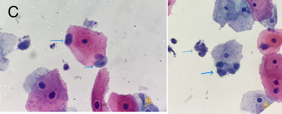 ⁉️ Critters in Pap⁉️SPOTTER !!!

What are the diagnoses in the given two cases?

Case 1: Picture A

Case 2: Pictures B and C

 #parasite #PathTwitter #pathology #surgpath