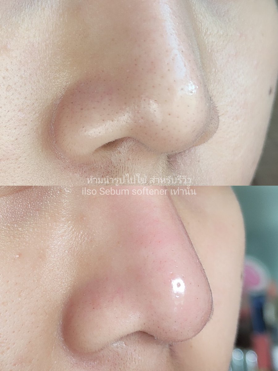 foxeryrose's tweet photo. โลชั่นละลายสิวเสี้ยนยี่ห้อหนึ่งใช้โคตรดี!!  ภาพนี้ไม่ได้รีทัชเลย ใช้เสร็จ 20 นาที ใช้แปรงล้างหน้าวนตรงจมูกอีกรอบ ล้างออก ถ่ายรูปอีกรอบสิวเสี้ยนหลุดออกมาเยอะมาก🙀 https://t.co/R7ELnMFDuK