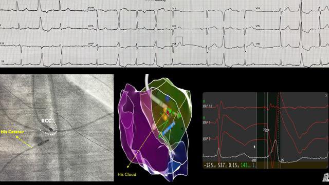 Pablo Salazar, MD (@pabsala) on Twitter photo Parahisian PVC, always a challenge to ablate arrhythmias in this region. “We aware of your neighbors <a href="/DrFerminGarcia/">Fermin Carlos Garcia</a> used to say”. Ablated from RCC. <a href="/andresenriqueza/">Andres Enriquez</a> <a href="/FellowEP/">Luis Quininir, MD ECES FACC 🇨🇱</a> <a href="/DrRoderickTung/">Roderick Tung</a> <a href="/hhuang123/">Henry D. Huang</a> Parahisian PVC, always a challenge to ablate arrhythmias in this region. “We aware of your neighbors <a href="/DrFerminGarcia/">Fermin Carlos Garcia</a> used to say”. Ablated from RCC. <a href="/andresenriqueza/">Andres Enriquez</a> <a href="/FellowEP/">Luis Quininir, MD ECES FACC 🇨🇱</a> <a href="/DrRoderickTung/">Roderick Tung</a> <a href="/hhuang123/">Henry D. Huang</a>