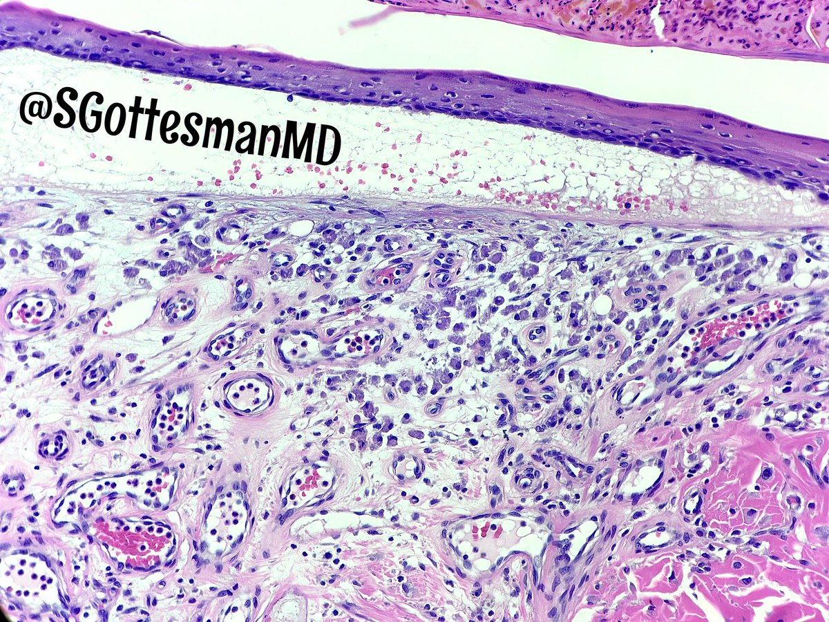 Lavender granular histiocytes also known as Aluminum Chloride Histiocytes 
🪁 A really nice proof that this is the site of previous biopsy 
🪁can be highlighted with PAS stain 
🪁our paper with <a href="/JakkiPath/">Junkins-Hopkins</a> pubmed.ncbi.nlm.nih.gov/28875554/
#reallifedermpath #dermpath #pathology