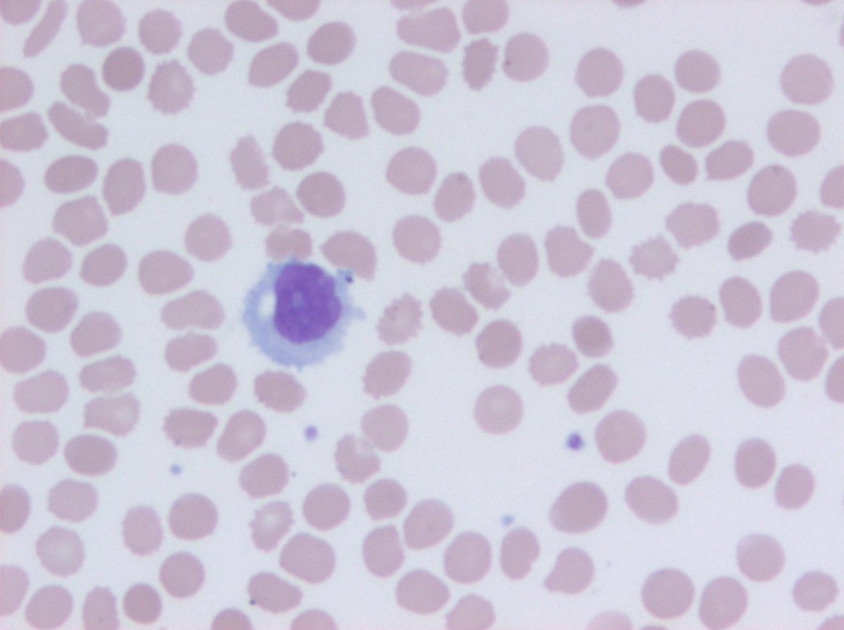 Interesting one; older adult with lymphocytosis splenomegaly 🤓
