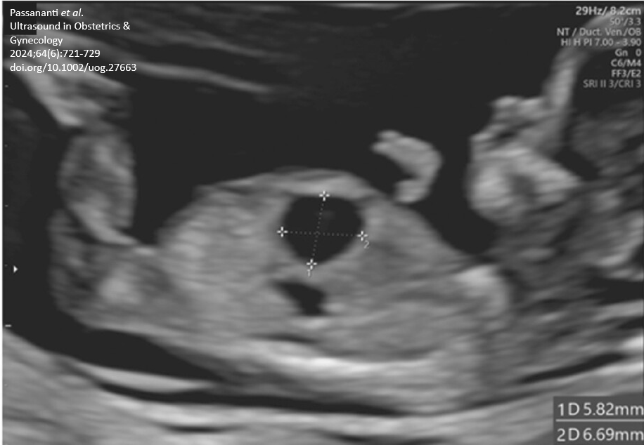 ISUOG's tweet photo. Open-access systematic review by Passananti et al. in December #UOGJournal report that diagnosis of an isolated fetal abdominal cyst is usually associated with moderate-to-good prognosis, but may precede the development of associated abnormalities. https://t.co/souvZwhbw6 https://t.co/Ksf1Yt1WAW