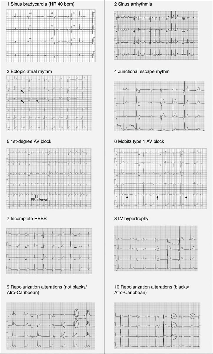 ECG patterns of athlete's heart 

researchgate.net/figure/Electro…